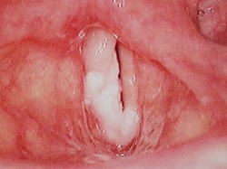 Picture of Carcinoma