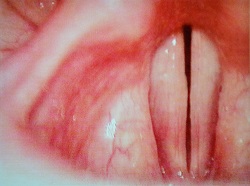 Picture of Laryngitis