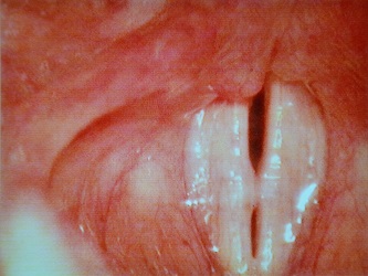 Picture of Nodules