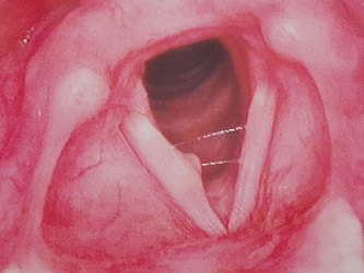 Picture of Polyp